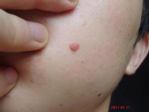 皮肤本来就有青春痘,但是最近脸长了一颗这样的肉疙瘩