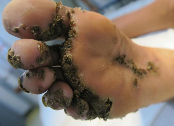 "有些病人病情非常严重,他们的皮肤中生活着1000多只寄生虫.