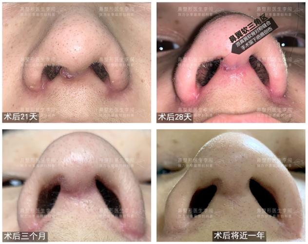 亚洲人皮肤的特点容易出现疤痕增生等问题,因此即使面诊时对顾客说明