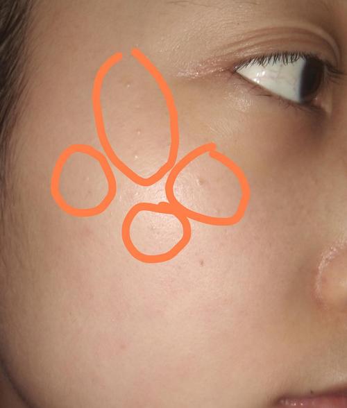 在线等专业回答好像是栗丘疹