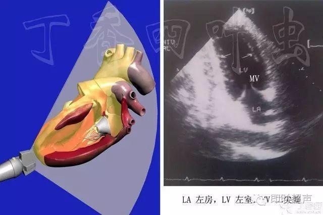 心尖二腔切面——心动态图六,心尖的五腔切面在心尖的四腔切面基础上