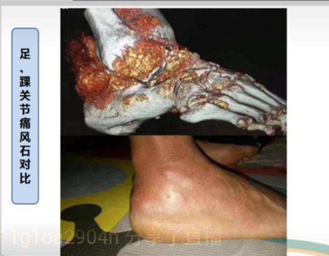 这张照片,痛风发作时脚踝的外观我们很常见,但是,透过ct三维重建看到