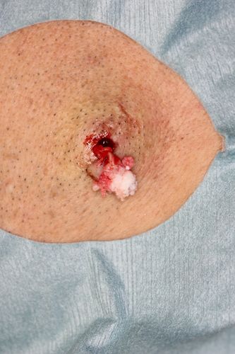 粉瘤- ssクリニック - 皮肤科99美容外科 - 名古屋