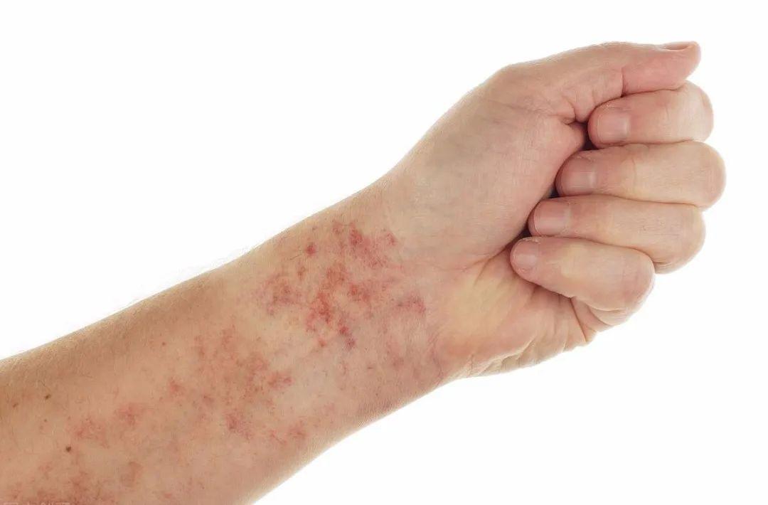 过敏性紫癜并发症来了,肾脏比你先知道!这4个前兆要记