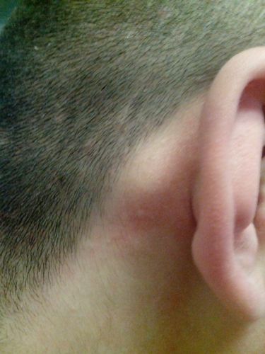 耳朵后面长了一个包包 问下是怎么回事 有点像骨头 而且摸起来不疼