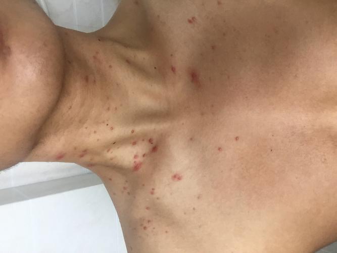 不会是艾滋病吧! 附件