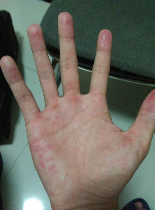 手里长红点,有时有点痒,手指肚还脱皮是怎么回事?