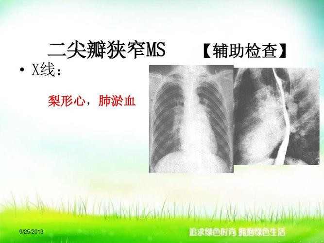 高等教育 医学 11心脏瓣膜病病人的护理ppt  二尖瓣狭窄ms   x线: 梨