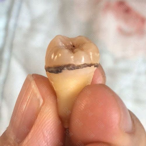 拔了智齿发现这个,这难道是传说中的牙结石吗?