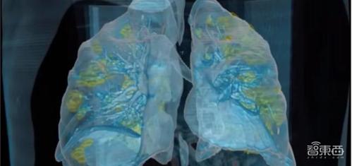 美国医院vr影像展示新冠肺炎患者肺部肺损伤或