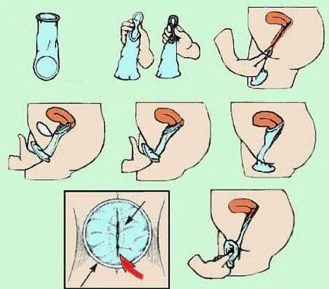 女用避孕套使用方法(图)