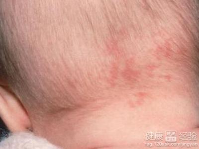 红胎记是鲜红斑痣吗?