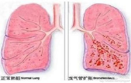 关于支气管扩张的治疗与保养