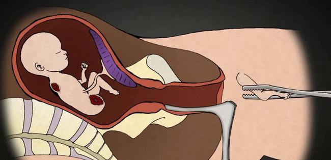 堕胎手术时胎儿会疼吗揭秘无痛人流的真相