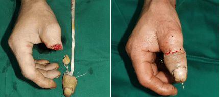 健强手足医院丨关于断指再植你都知道哪些常识