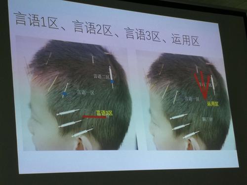 头针电针示意图