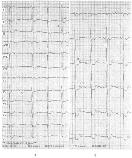 室性早搏二联律: 治疗剂量的洋地黄可以使室性早搏消失.
