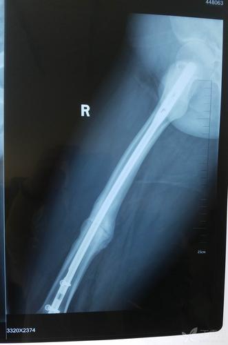 看这例股骨干骨折术后接下来将如何处理?