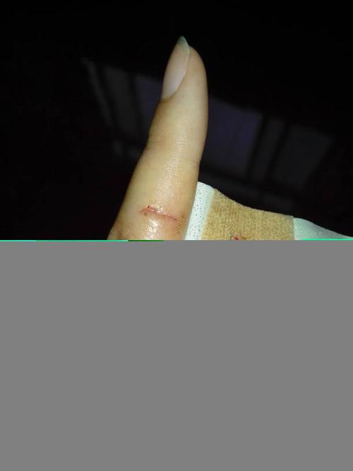 去医院消毒后贴了创口贴,今天中午发现食指伤口又疼又麻,连带
