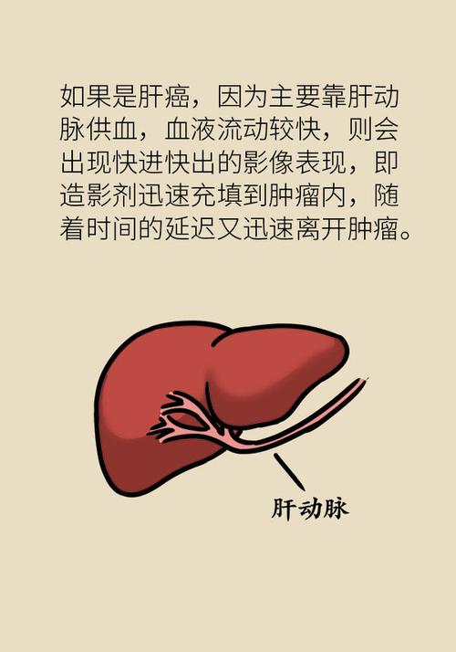 肝血管瘤是癌症一般小于10cm的血管瘤定期复查即可