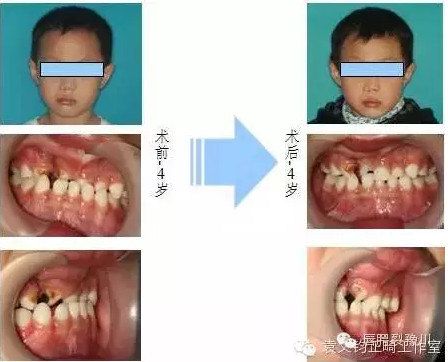 病例一:lsh,女性,右侧唇腭裂,牙槽突裂   唇腭裂患儿乳牙期的早期