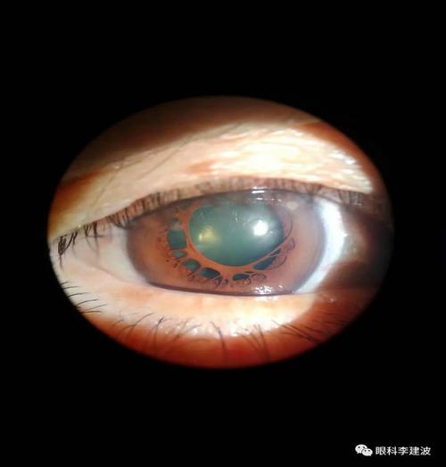 先天性虹膜残膜