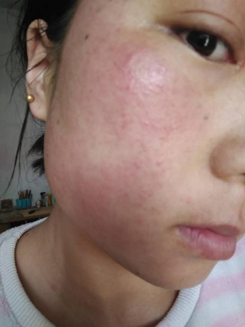 我家表妹,过敏性皮炎,用小蜜膏改善的案例