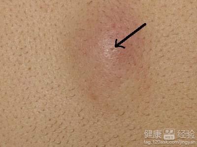 正文 2减少摄取油炸,辛辣,坚果类食品:这一类食物容易激发面疱粉瘤的