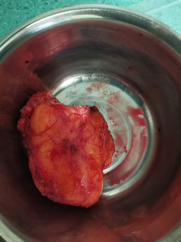 脂肪瘤要不要切除