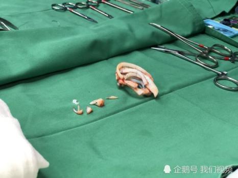 用爱"种下梦想的种子"为缺陷患儿再造一对正常的耳朵