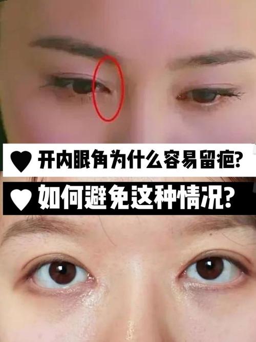 开内眼角为什么容易留疤如何避免这种情况