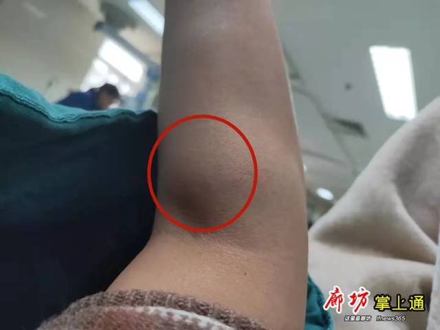 10月28日,王女士胳膊上的肿包!