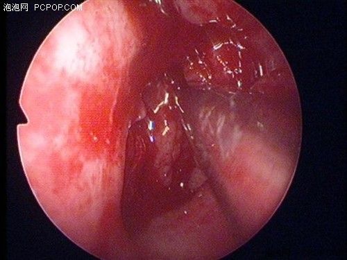 正常鼻腔内部结构图