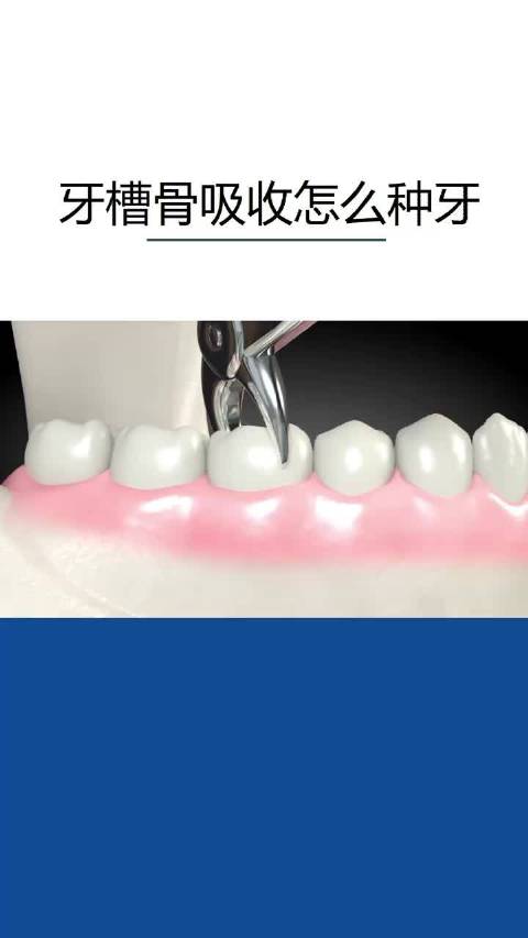 牙齿缺失太久,牙槽骨吸收,怎么种植牙齿.一起来看看吧