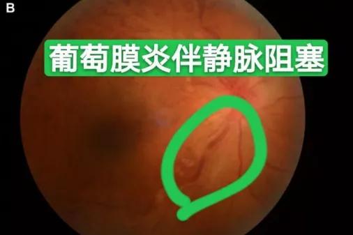 症状体现不同年龄段均可发生葡萄膜炎,青壮年尤为多见.