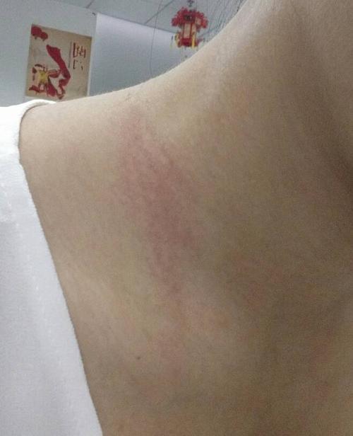 脖子好像是对衣服的金属项链配饰过敏,昨天开始痒,都抓红了,不能擦药