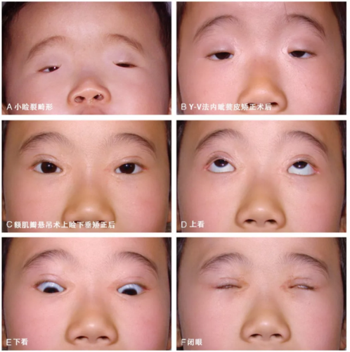 眼睛长得太小,竟然是种病?