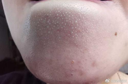 下巴上很多密密麻麻的闭口冒白头