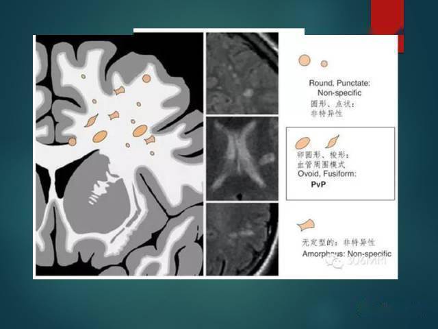 脑白质疏松( la ) : 小动脉病变导致的白质纤维脱髓鞘;t2-f