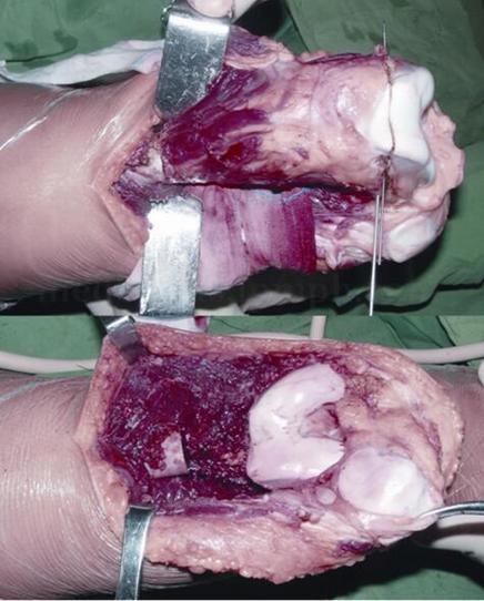 牵拉成骨延长手术的适应证如何选择?