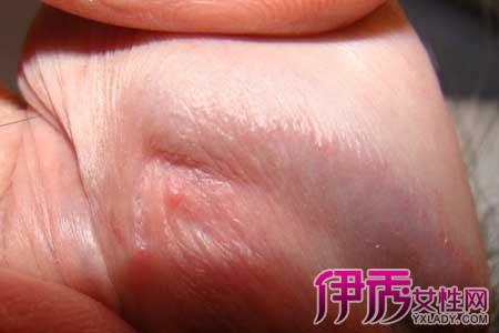 【图】男性初期尖锐湿疣 男性尖锐湿疣的常见特征有哪些