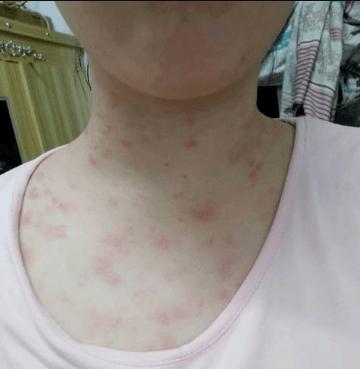 冬季容易发作的皮肤病之一玫瑰糠疹