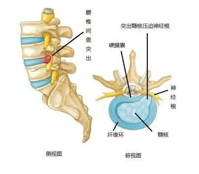 什么是腰间盘突出这篇文章讲得真好