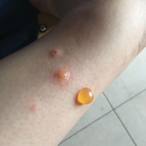 我前段时间得了虫咬性皮炎,大大小小一腿水泡