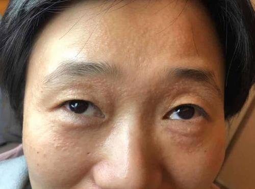 2年前长汗管瘤,学生的家长害怕我,现在汗管瘤终于消下去