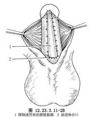 尿道下裂之膀胱黏膜尿道成形术
