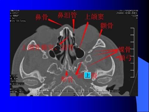 鼻和鼻窦ct解剖ppt