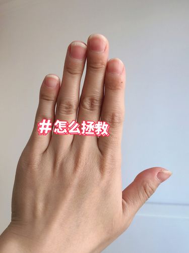 指甲短扁宽 !怎么拯救?_短指甲_医疗健康_医疗