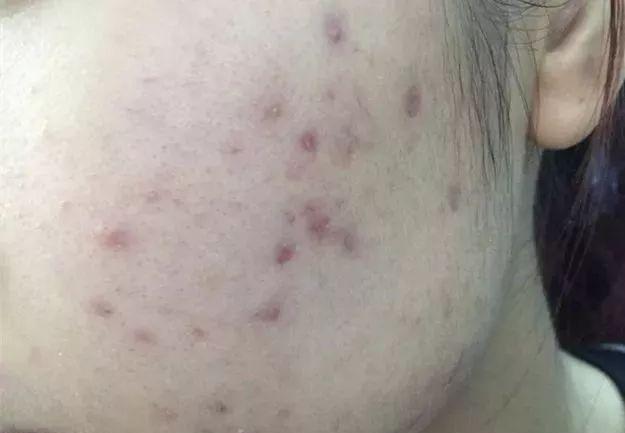 黑痘印是痘痘发炎后的黑色素沉淀,让长痘痘的地方留下黑色或褐色的