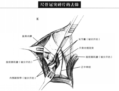 小动物骨科手术:尺骨冠突碎片的去除及分离性